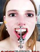 Mouth spreader, pic 4